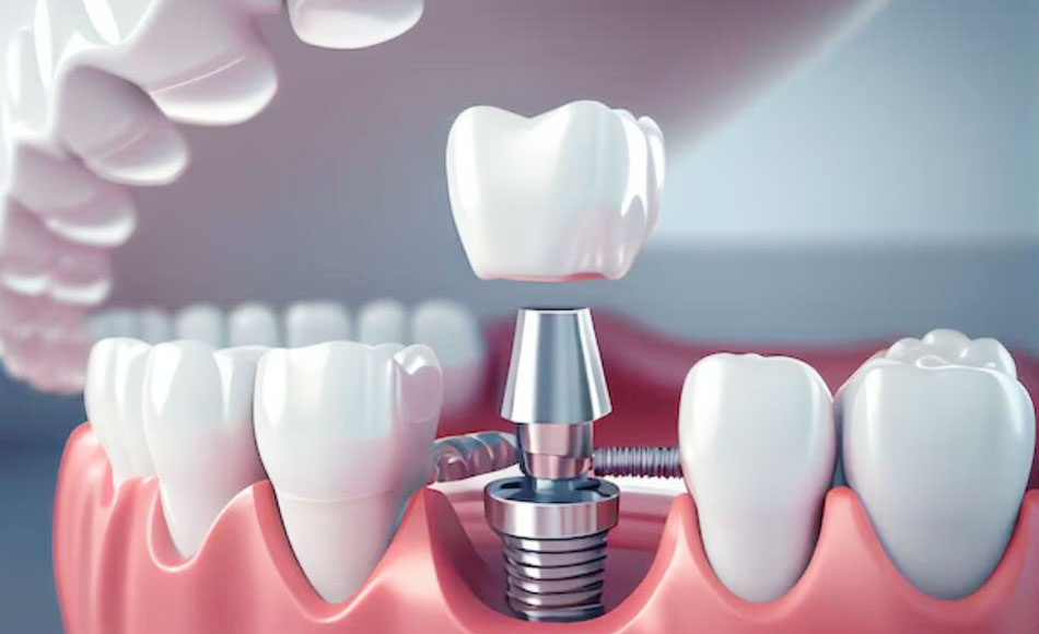 دانتوں کی ایمپلانٹس کے اجزاء کیا ہیں؟